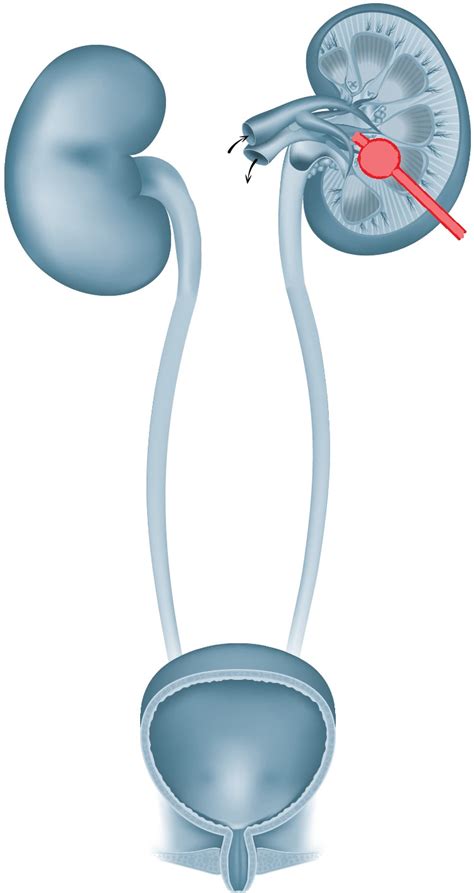 Perkutane Nephrostomie: Anlage einer Nierenfistel